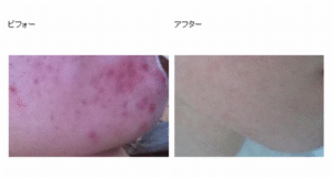 ニキビが出来ない皮膚を作り出す「ニキビ0ノウハウ」 三上怜奈